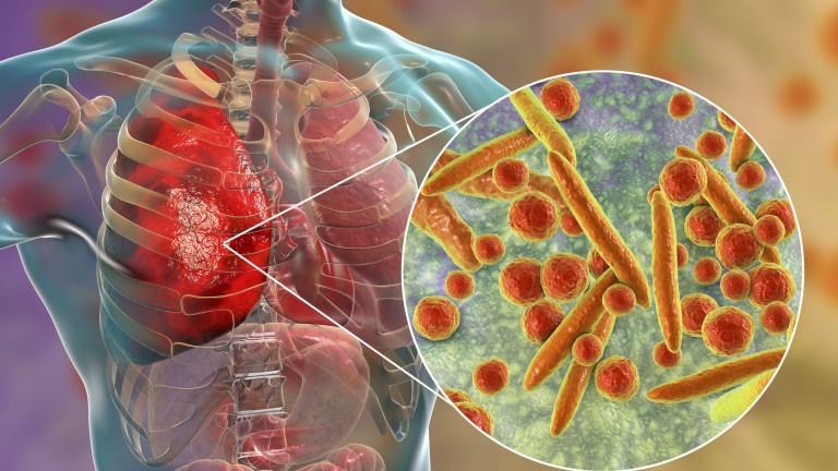 Mycoplasma pneumoniae